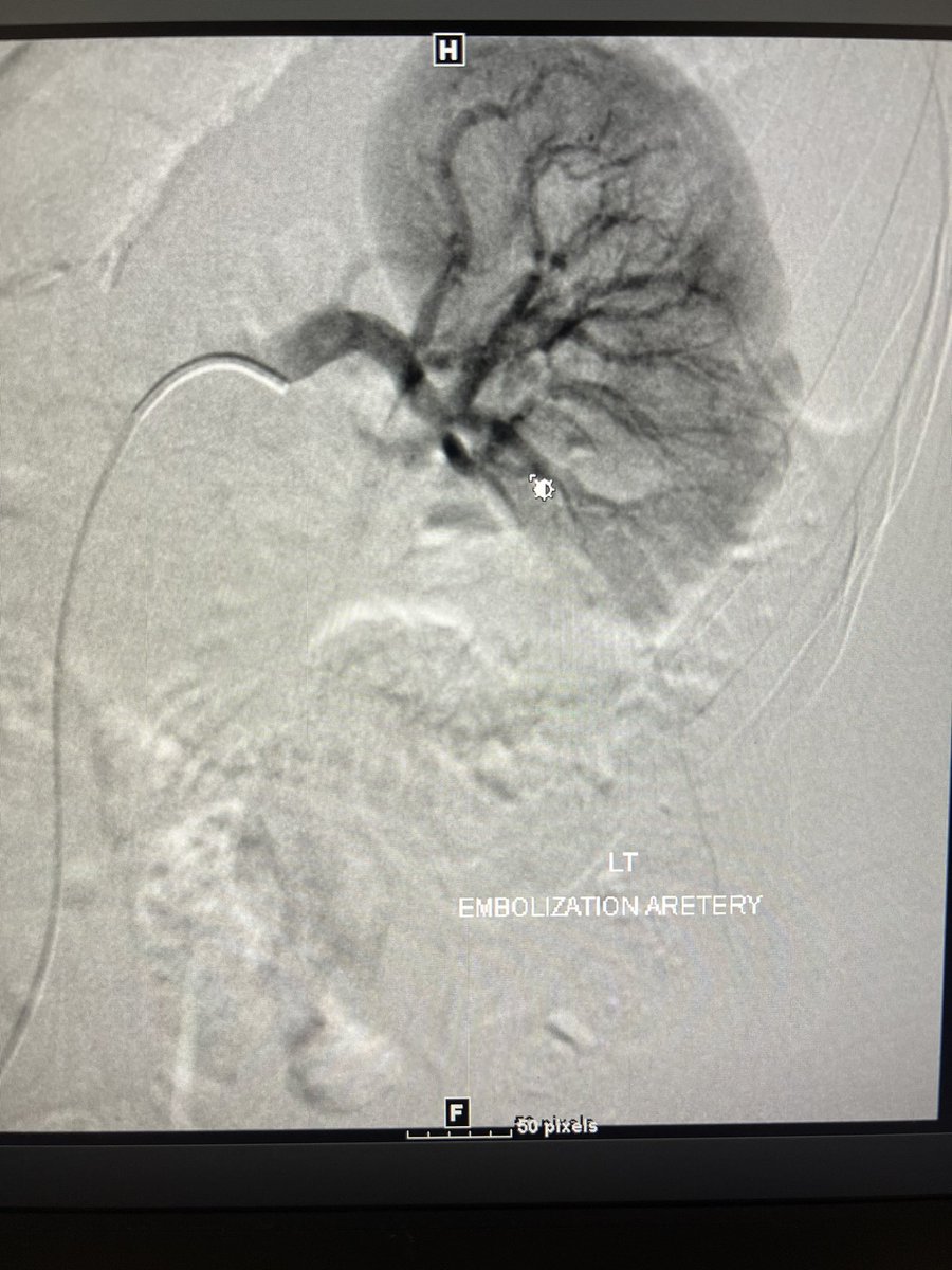 Fahad Aldawsari | فهد الفاران (@fahadaldawsari6) on Twitter photo Prophylactic pre-pregnancy TAE decreased the growth and bleeding of renal AMLs during pregnancy.<a href="/othman_Irad/">Dr.Othman Alshehri د.عثمان الشهري</a>,<a href="/sirs_ksa/">Saudi Interventional Radiology Society</a>,<a href="/SIRspecialists/">Society of Interventional Radiology</a>,<a href="/UTHouston_IR/">UT Houston_IR</a>,<a href="/pairsmedia/">PAIRS</a>,<a href="/TheRealDoctorOs/">Osman Ahmed</a>,<a href="/ahmed_kamel_ir/">Ahmed Kamel MD, PhD, FSIR</a> Prophylactic pre-pregnancy TAE decreased the growth and bleeding of renal AMLs during pregnancy.<a href="/othman_Irad/">Dr.Othman Alshehri د.عثمان الشهري</a>,<a href="/sirs_ksa/">Saudi Interventional Radiology Society</a>,<a href="/SIRspecialists/">Society of Interventional Radiology</a>,<a href="/UTHouston_IR/">UT Houston_IR</a>,<a href="/pairsmedia/">PAIRS</a>,<a href="/TheRealDoctorOs/">Osman Ahmed</a>,<a href="/ahmed_kamel_ir/">Ahmed Kamel MD, PhD, FSIR</a>