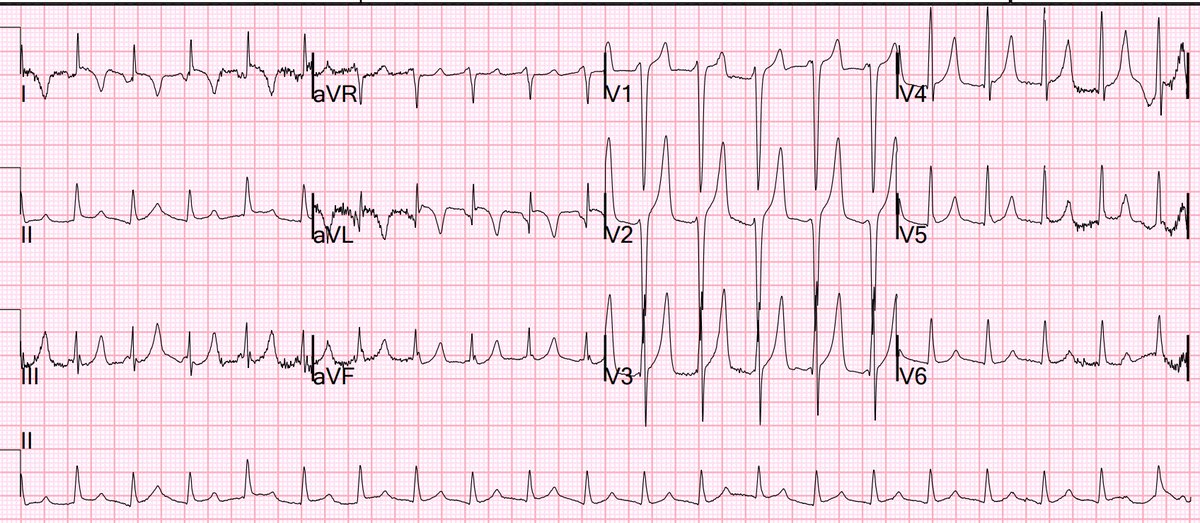 What are these hyperacute T waves, with STE and T-wave inversion in aVL, and STD in inferior leads?

hqmeded-ecg.blogspot.com/2023/02/what-a…