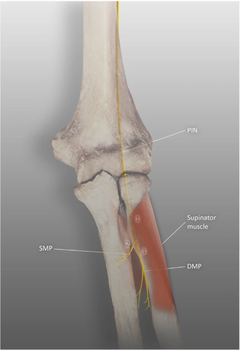 Recently came across a person with PIN compression neuropathy. 
A good read on compression neuropathies of the radial nerve. 

link.springer.com/article/10.100…