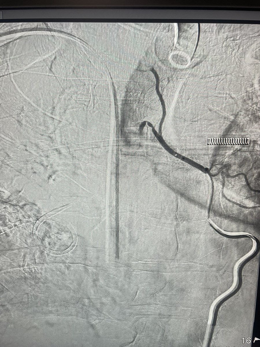 DLBCL with massive hemoptysis due COP. Bronchoscopy localized bleeding from the right. Right bronchial artery embolization was performed. What variance or aberrance have you personally encountered? <a href="/AzzamKhankan/">Azzam Khankan عزام خانكان</a> <a href="/AAlkenawi/">د. عبدالقادر القناوي</a> @SalmanFelemban <a href="/DrMajedAbdulhaq/">Majed Abdulhaq</a> #InterventionalRadiology