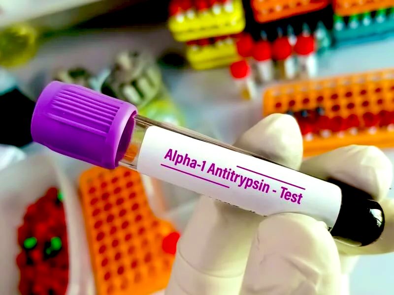 MohmdBio's tweet photo. Alpha-1 Antitrypsin 
تحليل لتشخيص امراض الرئة 🫁

عبارة عن بروتين يفرزه الجسم للوقاية من الخلايا البيضاء

نقصه يسبب تلف لانسجة الرئة  

مر عليكم التحليل من قبل ؟ 🤔

#مختبرات_طبية https://t.co/v21Ie9AS8t