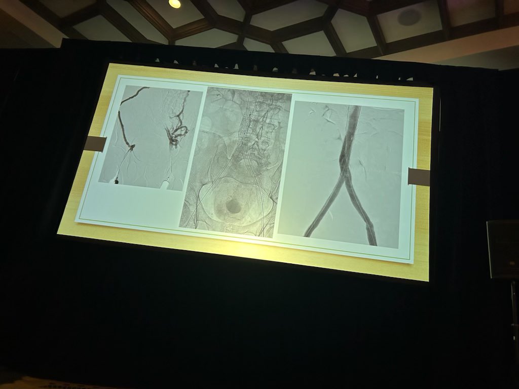 Andrew Barleben (@andrewbarleben) on Twitter photo Excellent presentation by @SZarrintan discussing the role of covered stents the role of chronic central venous occlusion. <a href="/VenousForum/">American Venous Forum | AVF</a>. Manuscript coming soon <a href="/JVSVL/">JVS - Venous and Lymphatic Disorders</a>. <a href="/UCSDsurgery/">UC San Diego Surgery</a> <a href="/UCSDHealth/">UC San Diego Health</a> <a href="/VESurgery/">VESurgery</a> Excellent presentation by @SZarrintan discussing the role of covered stents the role of chronic central venous occlusion. <a href="/VenousForum/">American Venous Forum | AVF</a>. Manuscript coming soon <a href="/JVSVL/">JVS - Venous and Lymphatic Disorders</a>. <a href="/UCSDsurgery/">UC San Diego Surgery</a> <a href="/UCSDHealth/">UC San Diego Health</a> <a href="/VESurgery/">VESurgery</a>