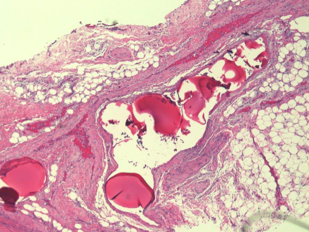 #pulmpath incidental finding in a lung resection specimen . @DZenezan @belogrivceva_e @MdTushir @whosainastro @TempleLung @AlisaNobee