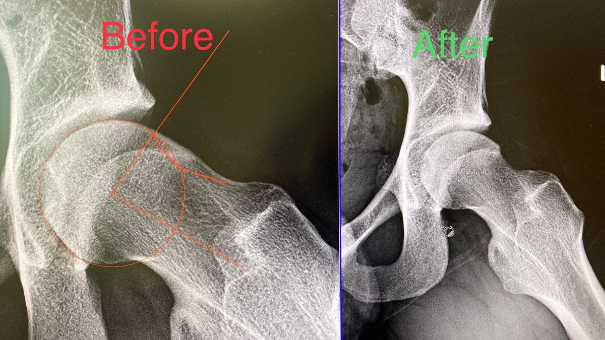 I had 3 patients this week as second opinions whose well meaning health care provider told them that #HipArthroscopy for #HipFAI doesn't work and they should live with their hip pain.
As long as this keeps happening, I'm going to keep tweeting.