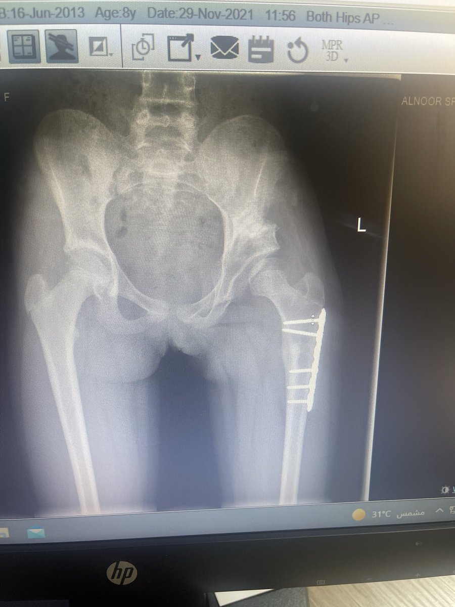 Ryan_Suqaty's tweet image. طفلة تبلغ من العمر 10 سنوات عانت من انزياح في مفصل الورك بعد عملية إرجاع مفتوح فقط في عمر السنتين 
تم إعادة ترميم الحقً مع تقصير عظمة الفخذ وتدويرها للخارج