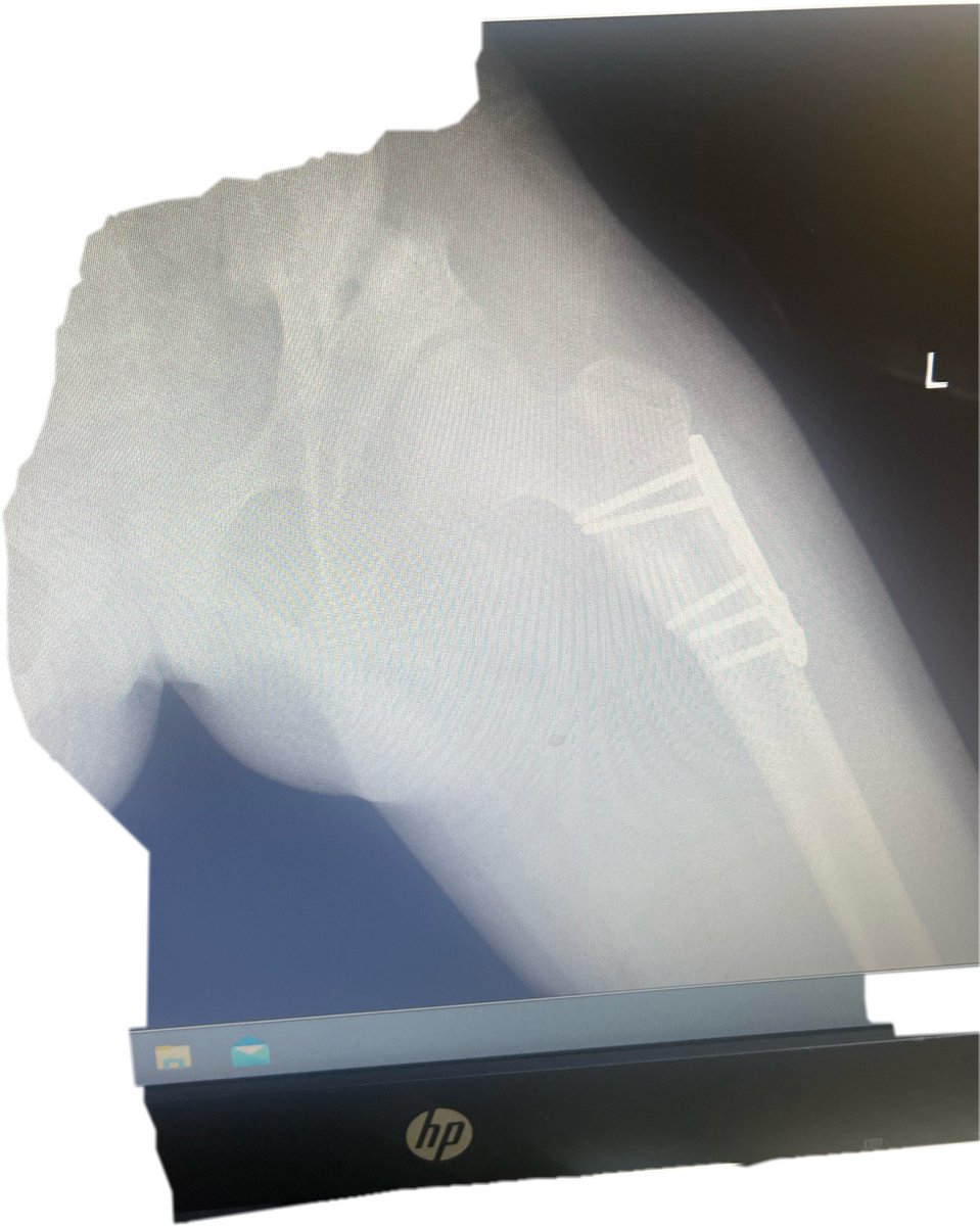 Ryan_Suqaty's tweet image. طفلة تبلغ من العمر 10 سنوات عانت من انزياح في مفصل الورك بعد عملية إرجاع مفتوح فقط في عمر السنتين 
تم إعادة ترميم الحقً مع تقصير عظمة الفخذ وتدويرها للخارج