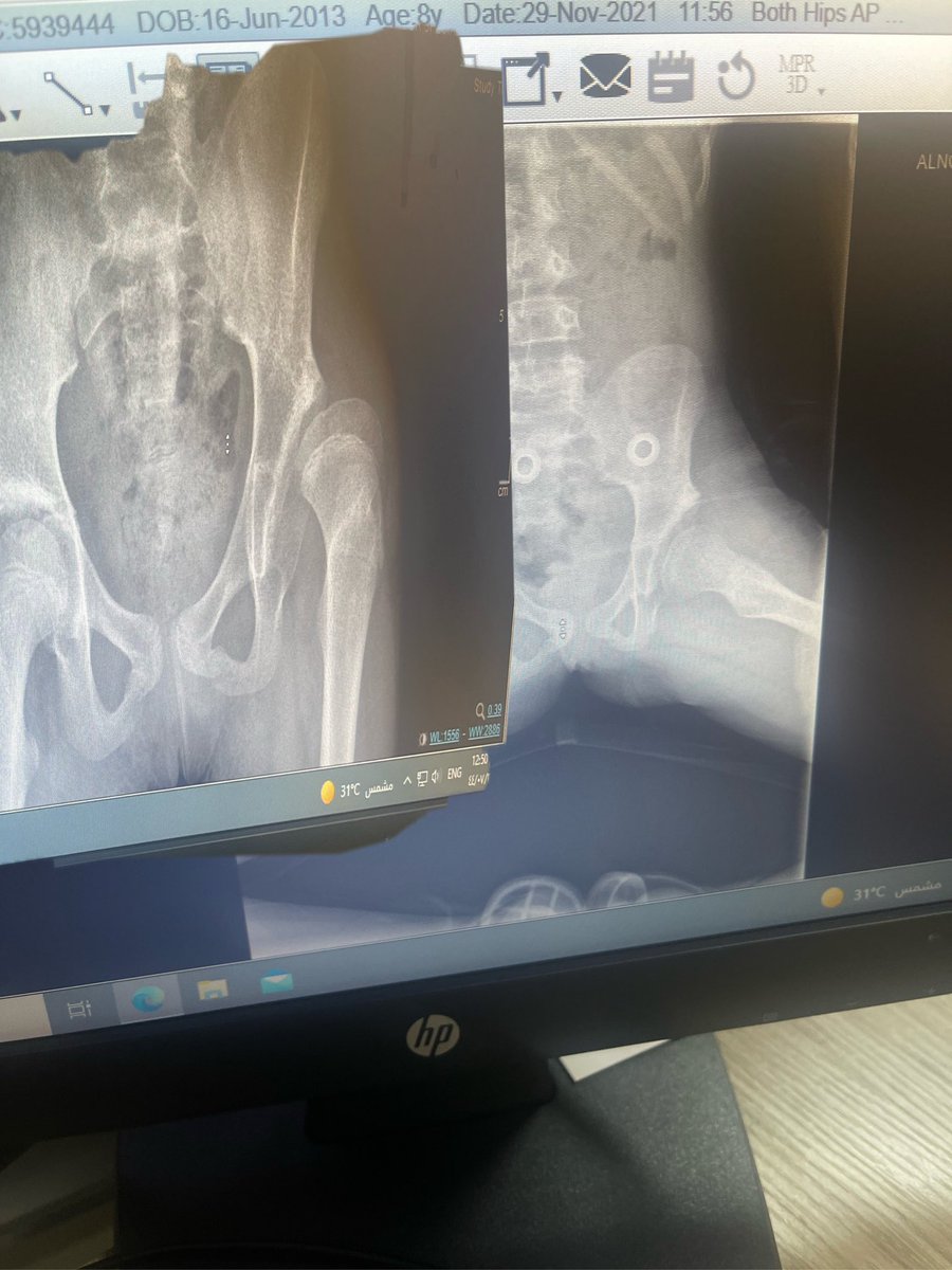 Ryan_Suqaty's tweet image. طفلة تبلغ من العمر 10 سنوات عانت من انزياح في مفصل الورك بعد عملية إرجاع مفتوح فقط في عمر السنتين 
تم إعادة ترميم الحقً مع تقصير عظمة الفخذ وتدويرها للخارج