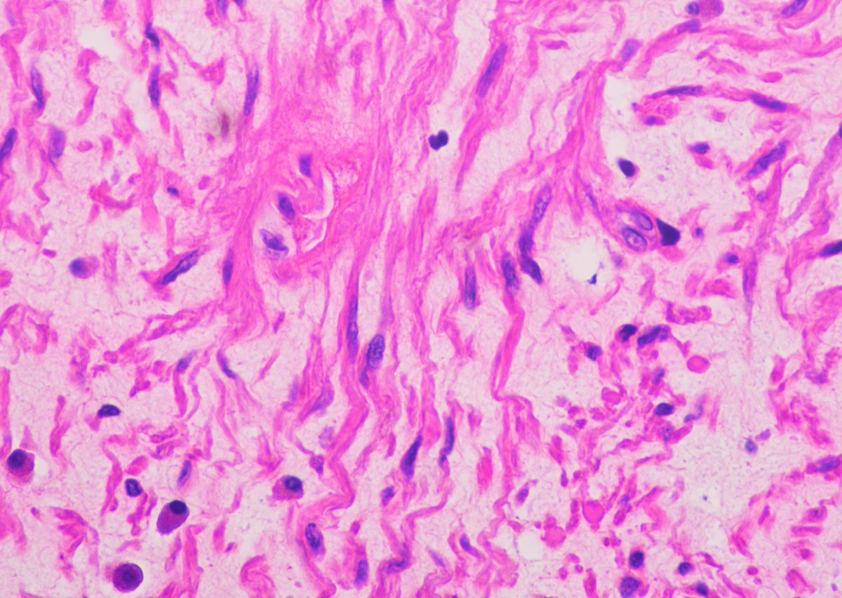 philly_path's tweet photo. Case of the week!
60 year old with incidentally found mediastinal cyst on imaging. Lets go #PathTwitter Differentials? Stains? Molecular maybe?
#pathology #bstpathology #pathresidents #histology #molecularpathology #molDx #Surgpath https://t.co/5IAkaU9Wqq