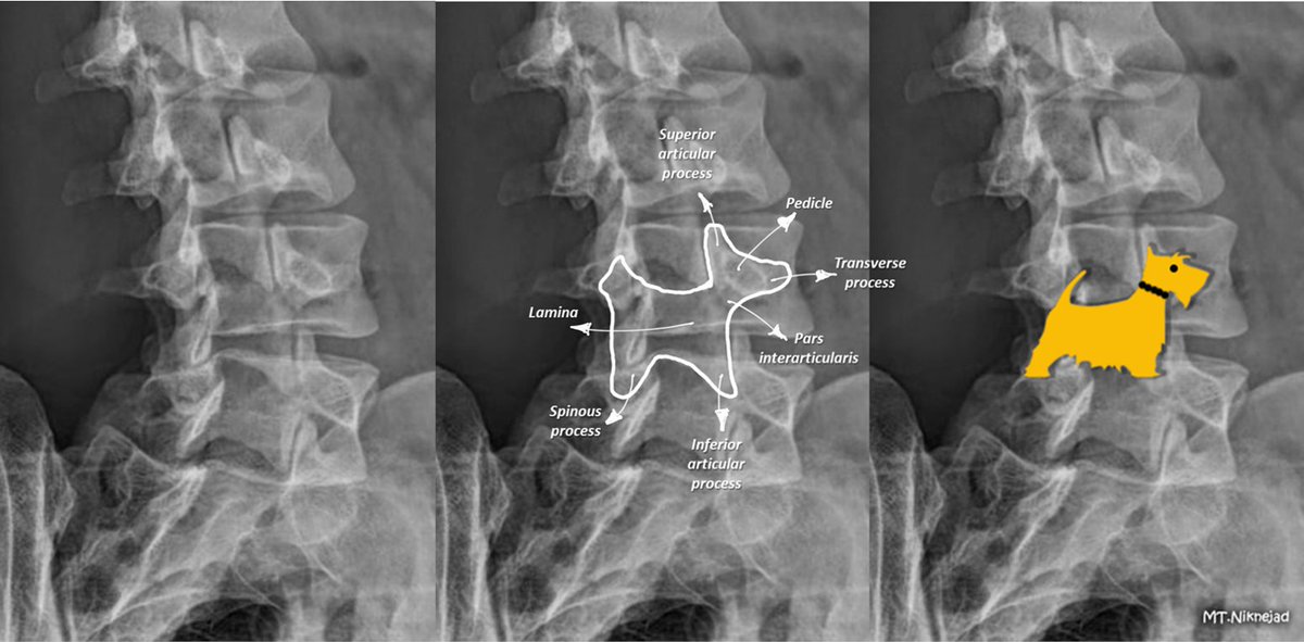 The Scottie dog #sign refers to the appearance of lumbar vertebra when seen on oblique view.
The collar #sign refers to a break in the pars interarticularis of the vertebra that resembles a collar around the Scottie dog's neck, inferring #spondylolysis.

radiopaedia.org/cases/collar-s…