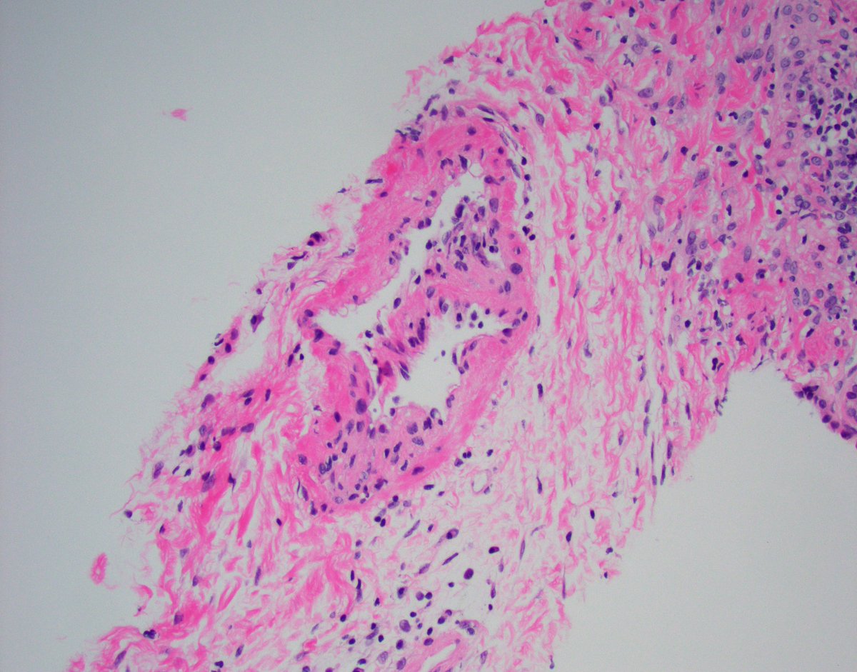 JZRenalPath's tweet image. Everyone&apos;s favorite lesion. perinephric artery with endotheliitis. Rest of biopsy showed at most borderline changes. Not diagnostic for rejection by Banff, but always worried about it. Close clinical follow up always recommended. #renalpath  #nephropath
