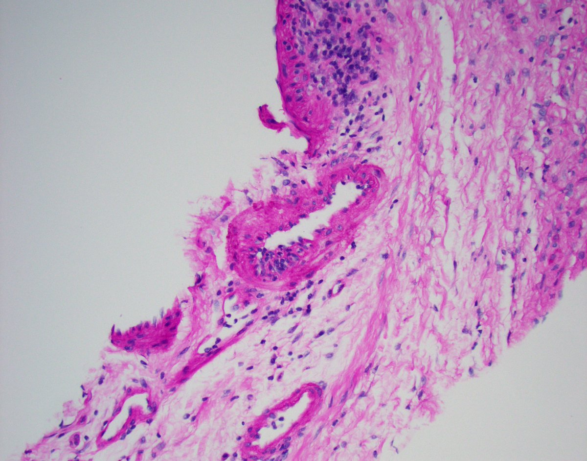 JZRenalPath's tweet image. Everyone&apos;s favorite lesion. perinephric artery with endotheliitis. Rest of biopsy showed at most borderline changes. Not diagnostic for rejection by Banff, but always worried about it. Close clinical follow up always recommended. #renalpath  #nephropath