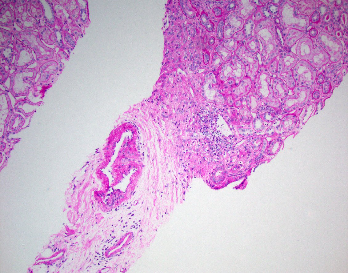 JZRenalPath's tweet image. Everyone&apos;s favorite lesion. perinephric artery with endotheliitis. Rest of biopsy showed at most borderline changes. Not diagnostic for rejection by Banff, but always worried about it. Close clinical follow up always recommended. #renalpath  #nephropath