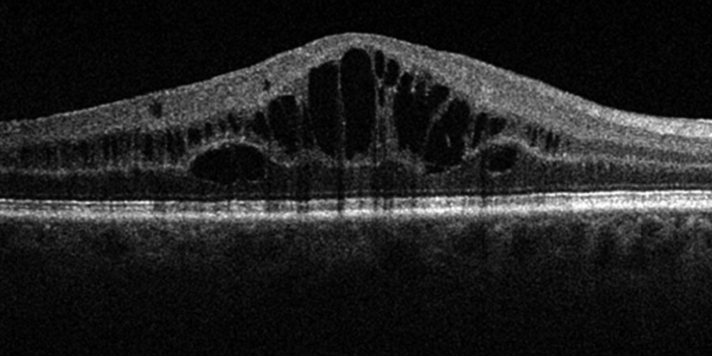 CollegeOptomUK's tweet photo. If you want to understand current and new treatments for #wetAMD, #DiabeticMaculaOedema and #BranchVeinOcclusion, book your spot at our #OptometryTomorrowBitesize webinar!
🗓️ 27 April, 7.30 - 8.45pm
✅ 1 CPD point available
➡️ https://t.co/ahjBDKhlXP https://t.co/cEypoFMniB