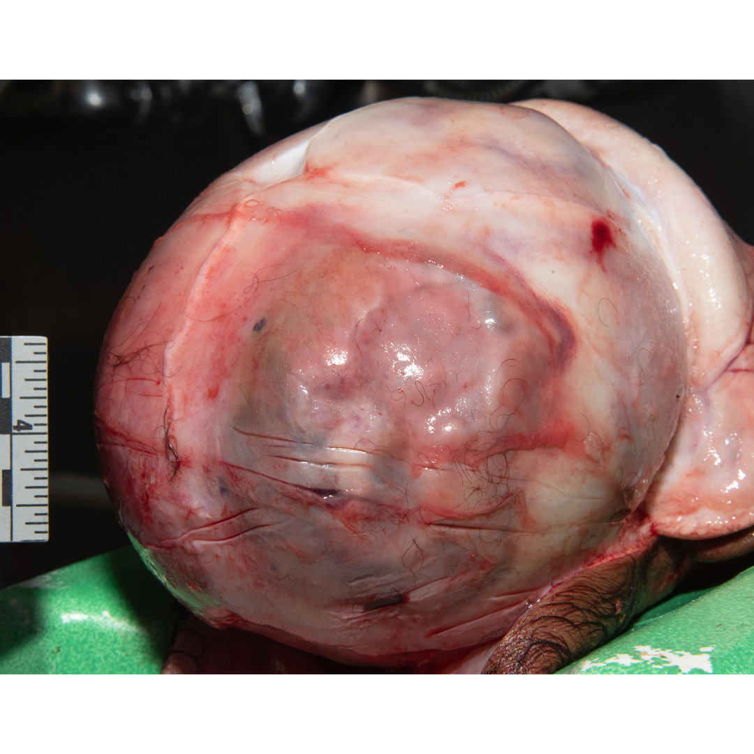 detroitsdocket's tweet photo. Specimen Saturday! Cephalohematoma is a type of birth injury that occurs when blood collects between the skull bone + fibrous covering of the skull called the periosteum. This is typically caused by trauma to the baby's head during delivery. Photos show a cephalohematoma. https://t.co/mqpwqcQYoz