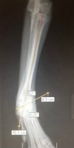 RiverHalling's tweet image. Surgical correction of angular limb deformity in a young dog. Asynchronous injury to the growth plates of the bones results in an angular forelimb, causing joint pain and limb dysfunction if left uncorrected. (See thread for post-op images)