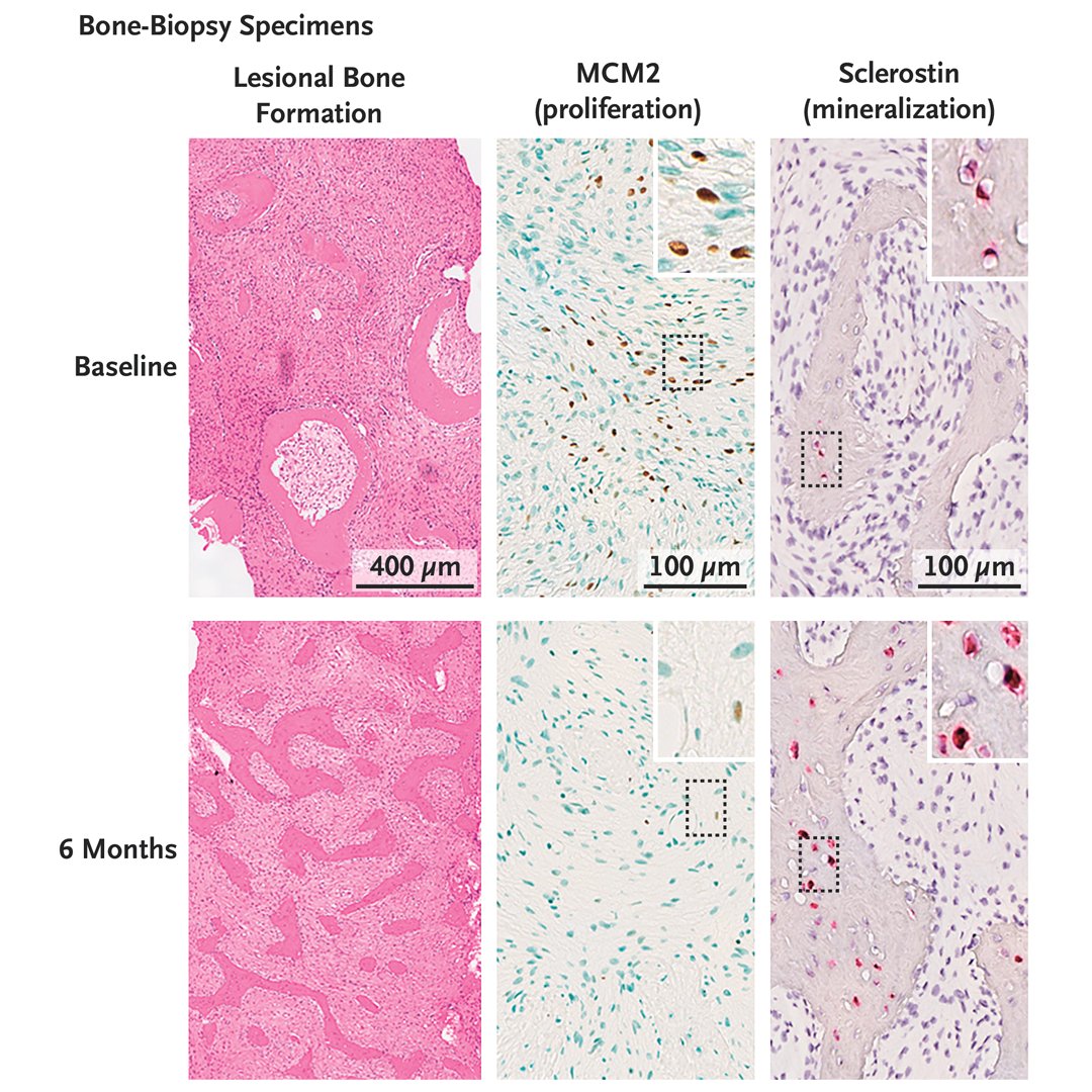 In this study involving patients with fibrous dysplasia of bone, denosumab was associated with marked reductions in the serum bone markers and with bony improvement. However, rebound hypercalcemia occurred. nej.md/3SoDO2y

#orthopedics