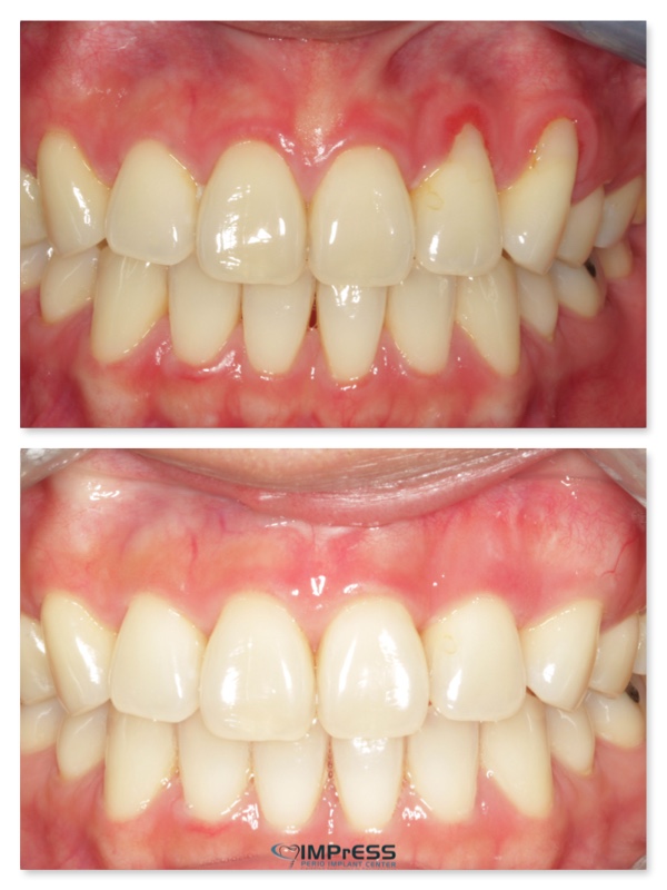 impressperio's tweet photo. Dr. Noroozi, certified specialist in Periodontics, in Vancouver and Burnaby, offers minimally invasive gum grafting microsurgery as an option when gum recession is a problem. 604-733-4867. #gumrecession #gumgrafting #dentalcare https://t.co/iNopjkUDE5
