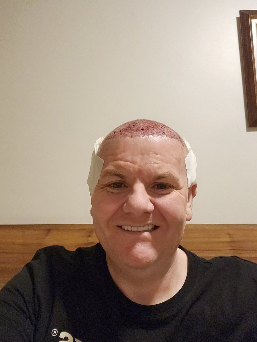 DARENWILLS's tweet photo. The last part of my reform, it started having my new teeth in November 2021 then the gastric sleeve September 2022 and now my hair having transplant, this has made my mental health much better even though people didnt want me to have them, but you all stood by me thank you 🙏 https://t.co/wvYFDhVtlF