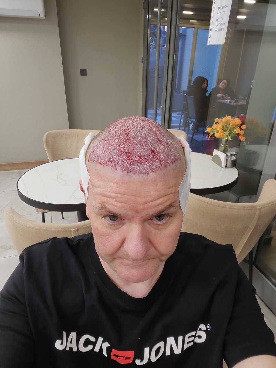 DARENWILLS's tweet photo. The last part of my reform, it started having my new teeth in November 2021 then the gastric sleeve September 2022 and now my hair having transplant, this has made my mental health much better even though people didnt want me to have them, but you all stood by me thank you 🙏 https://t.co/wvYFDhVtlF