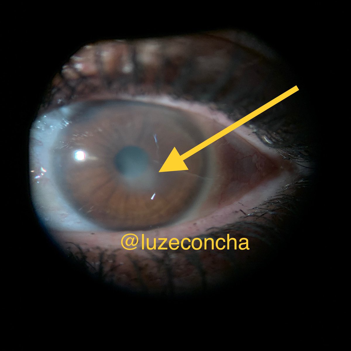 LuzEConcha's tweet photo. El virus del herpes simple (VHS) es una de las principales causas infecciosas de opacificación corneal grave y neovascularización.
#herpes #leucoma #ojorojo #malavision #AprendiendoUveitis https://t.co/npMiy3yzr5