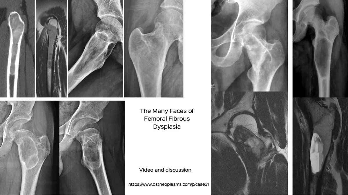 The Many Faces of Femoral Fibrous Dysplasia

Discussion video

bstneoplasms.com/p/case31

#bstneoplasms #bonetumor #radres  #femur #fibrousdysplasia