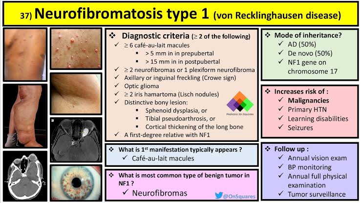 @BrownJHM Neurofibroma and Cafe au lait spots

Seen in Neurofibromatosis type 1
Also known as Von Recklinghausen disease

NF 1: Autosomal dominant
NF gene on Chromosome 17