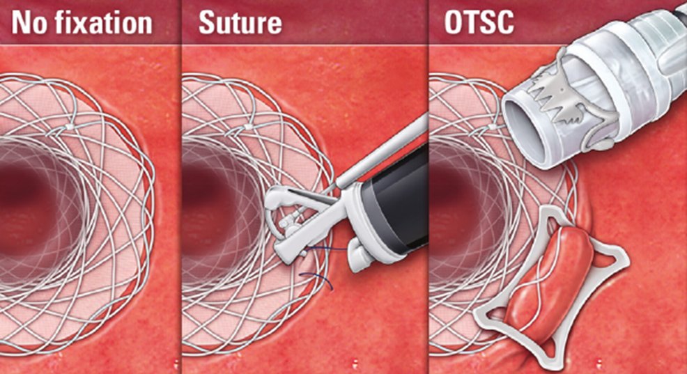 Los stents totalmente cubiertos tienen la mala costumbre de migrar. ¡Una lata!
¿Sabías que al menos ahora hay 2 dispositivos disponibles para fijarlos?
Parece lógico que sirvan pero ¿se ha demostrado su utilidad?🤔
Vamos con un #HiloAEG🧵 
#EndojuevesAEG en domingo😜