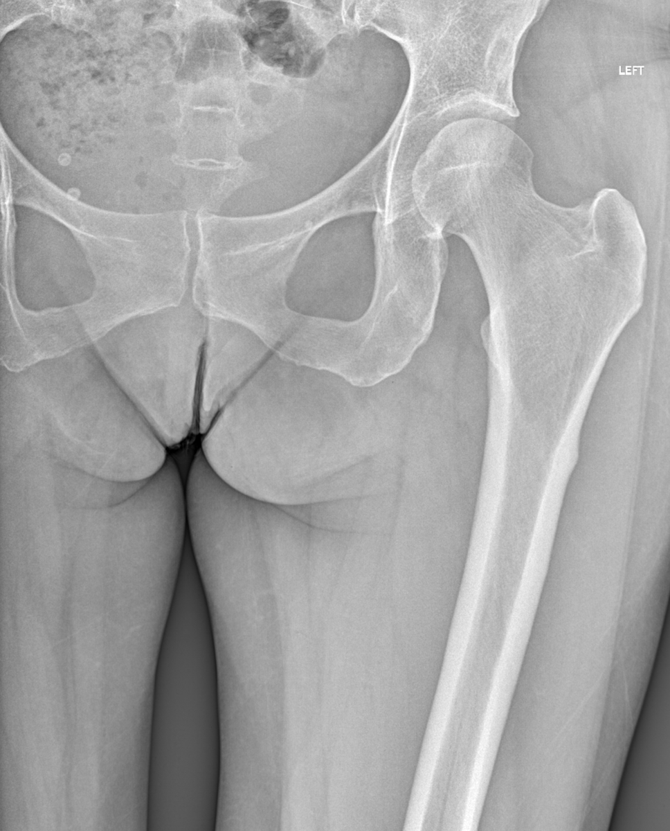 mskteachingroom's tweet photo. 61 ♀️ left hip pain. No history of trauma.

What has happened❓

Comment below in GIFs! 🙏

Some great reading material also coming up! Watch this space😎

#radfellow #radres #learningradiology #radres #mskrad #radtwitter #radiology #transformingradiology #mri https://t.co/HyU9hRTroA