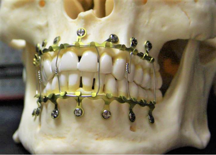 In the year 1870, Hammond first introduced arch bars in the field of maxillofacial trauma surgery to aid fixing broken jaws. Over the last 150 years the Arch bar basic design still continues to survive the test of time although with many added modifications