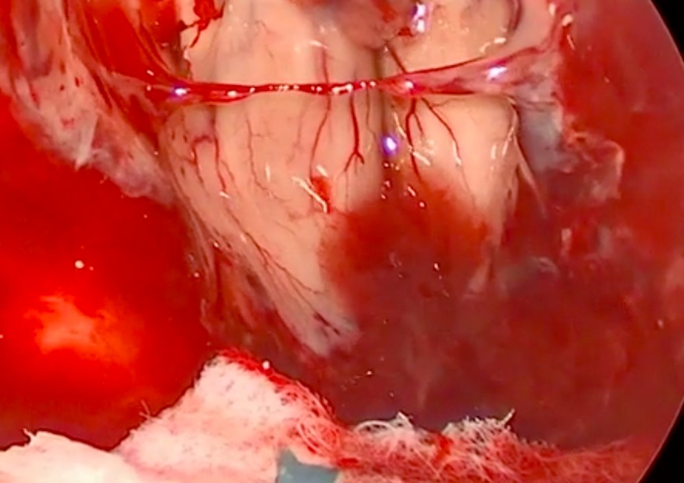 #nsgy #OpVid from <a href="/BradZachariaMD/">Brad Evan Zacharia</a> <a href="/PennStNeurosurg/">Penn State Neurosurgery</a> demonstrating the Expanded #Endoscopic Endonasal Resection of Retrochiasmatic Craniopharyngioma #approaches #neurosurgery #neuroonc #education 
Text: thieme-connect.com/products/ejour…
Video: youtu.be/tahjHmrXhc4