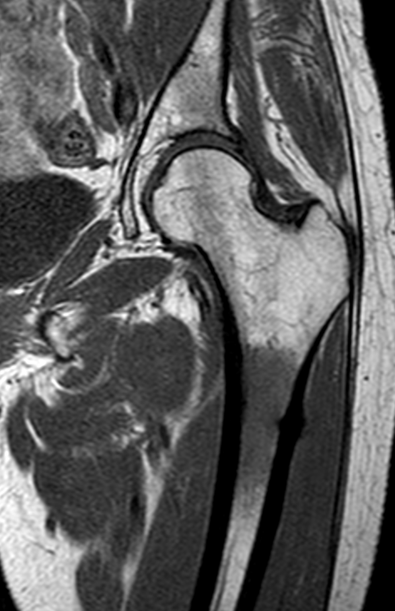 mskteachingroom's tweet photo. 61 ♀️ left hip pain. No history of trauma.

What has happened❓

Comment below in GIFs! 🙏

Some great reading material also coming up! Watch this space😎

#radfellow #radres #learningradiology #radres #mskrad #radtwitter #radiology #transformingradiology #mri https://t.co/HyU9hRTroA