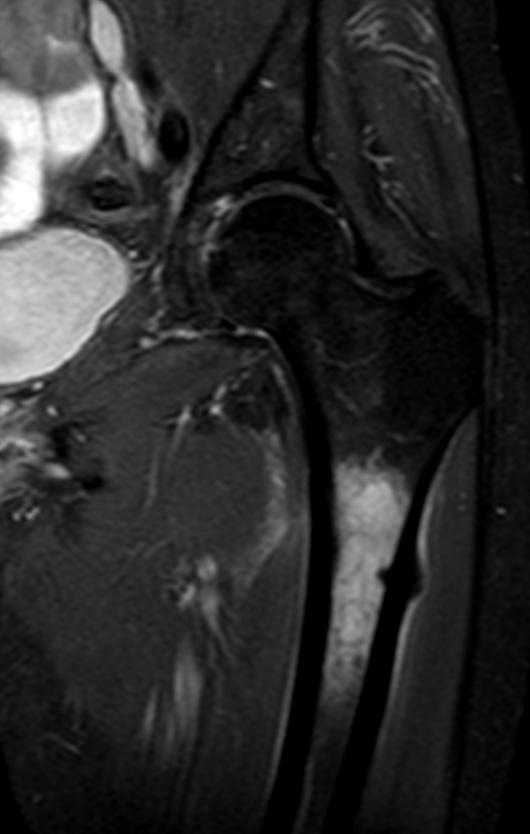 mskteachingroom's tweet photo. 61 ♀️ left hip pain. No history of trauma.

What has happened❓

Comment below in GIFs! 🙏

Some great reading material also coming up! Watch this space😎

#radfellow #radres #learningradiology #radres #mskrad #radtwitter #radiology #transformingradiology #mri https://t.co/HyU9hRTroA