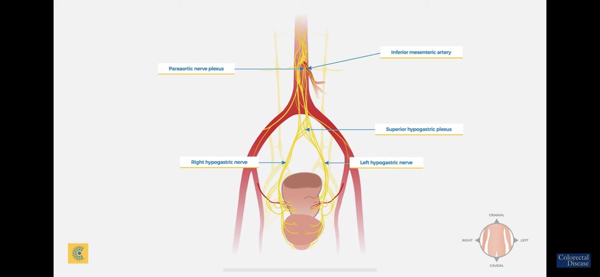 ColorectalDis's tweet image. 🎁#CodiSundays 🎁

@escp_tweets &amp;amp; @colorectaldis look at: 

✨🔬Anatomy of the Rectum🔬✨

✅ A 5️⃣-part video developed by @escp_tweets / European School of Coloproctology 

🔗link🔗

youtu.be/QJhh33aC_aw

#SoMe4Surgery #colorectalsurgery