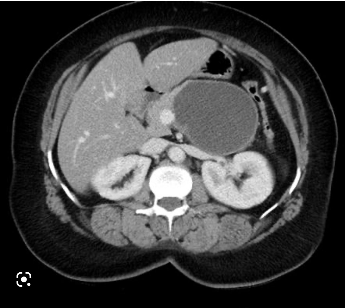 Mucinous cystic neoplasms of the pancreas 🐡 are they all surgical candidates ?!

🥑 Size &lt; 4cm, normal CA19.9 and no mural nodules exclude invasive cancer

🪡 Pro surgery advocates cancer prevention and usually MIS

Your practice ?! 

surgjournal.com/article/S0039-…