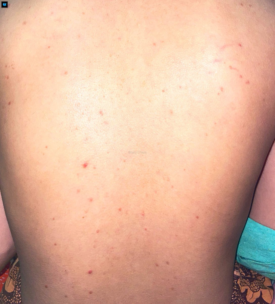 Askrlfess on Twitter "[askrl] PENYEBAB JERAWAT PUNGGUNG TU KENAPA SIH