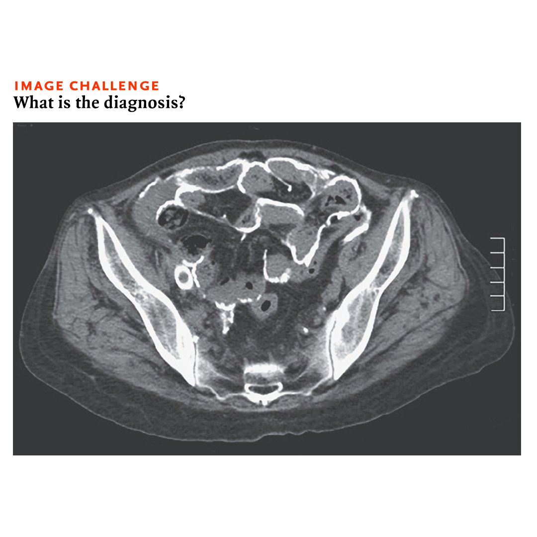 NEJM's tweet photo. A 52yo woman with end-stage kidney disease that was being managed with peritoneal dialysis presented with a 1-month history of bloody dialysate. She had had 3 episodes of bacterial peritonitis in the past 12 years. What is the most likely diagnosis? https://t.co/kQrNuVExlQ https://t.co/uEB6O3lSvV
