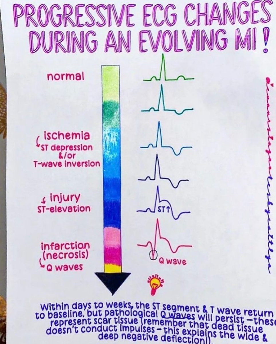 yoursmedico's tweet photo. Progressive ECG changes during an evolving MI
#MedEdChat #MedEd #medtwitter #MedTwitterSelective
#neetpg2022counselling #NEETUG2022 #neetug2022counselling #NEETPG2023 https://t.co/rRpgcNDGq0