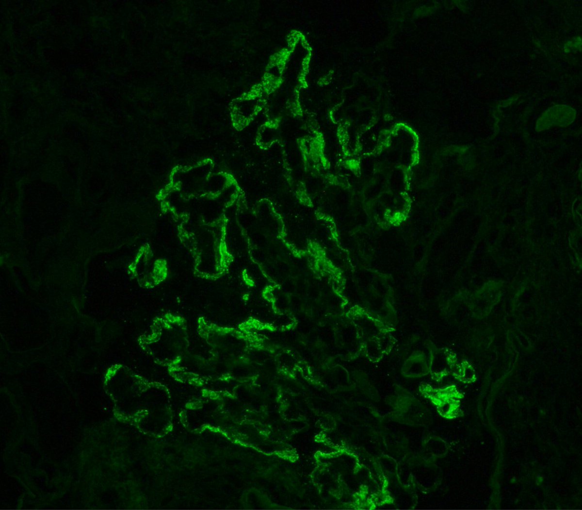 JZRenalPath's tweet image. Great example of the segmental subepithelial deposits in a case of NELL-1 (+) membranous nephropathy. [IgG IF; and NELL-1 IHC pictured]. Notice also NELL IHC shows background podocyte staining; must see deposits stain to call positive.  #renalpath #nephropath