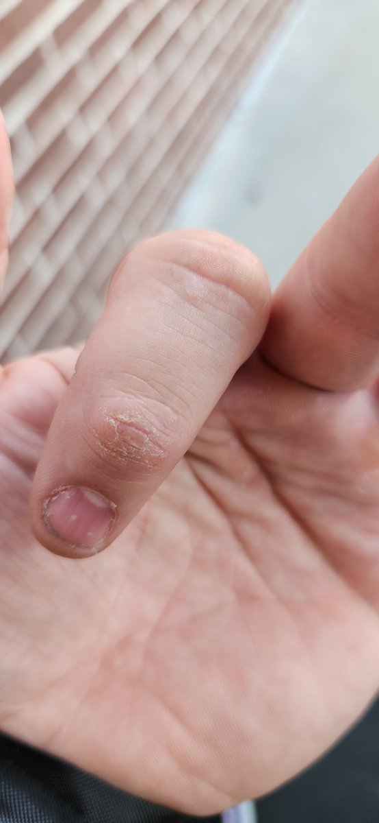 TheDocsMusic's tweet photo. @DrJuanGavin Have the same. Dr says it it likely eczema even though it is limited to knuckles only. No creams have worked. It has not been tested. Looks similar. you can see the secondary knuckle skin starting to thicken which is how the first began. This is happen on every finger both hand. https://t.co/tLUnS6MV1M