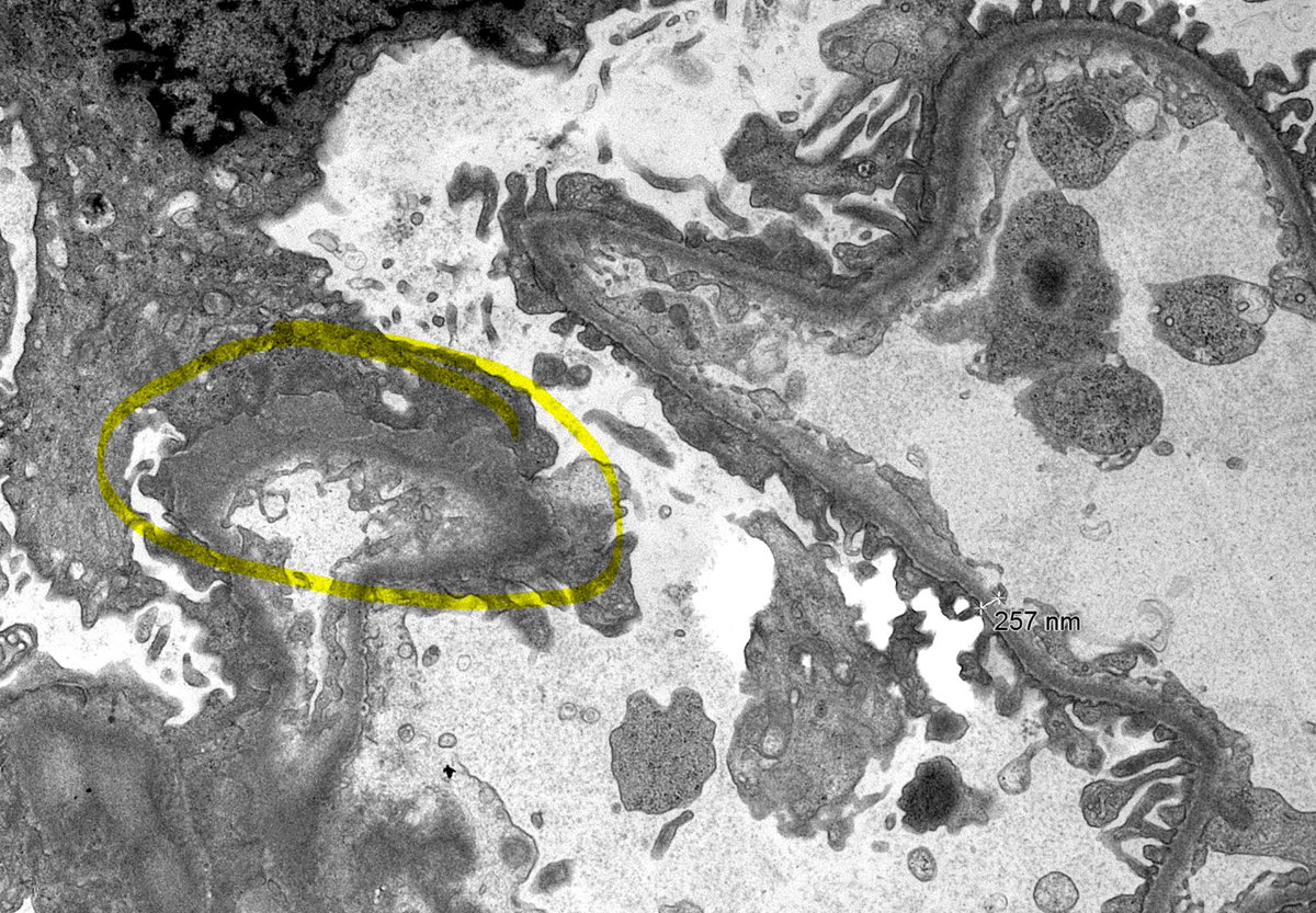 JZRenalPath's tweet image. Great example of the segmental subepithelial deposits in a case of NELL-1 (+) membranous nephropathy. [IgG IF; and NELL-1 IHC pictured]. Notice also NELL IHC shows background podocyte staining; must see deposits stain to call positive.  #renalpath #nephropath