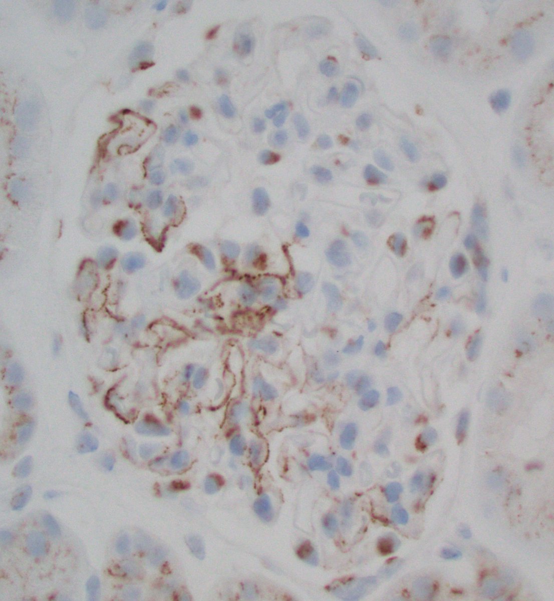 JZRenalPath's tweet image. Great example of the segmental subepithelial deposits in a case of NELL-1 (+) membranous nephropathy. [IgG IF; and NELL-1 IHC pictured]. Notice also NELL IHC shows background podocyte staining; must see deposits stain to call positive.  #renalpath #nephropath