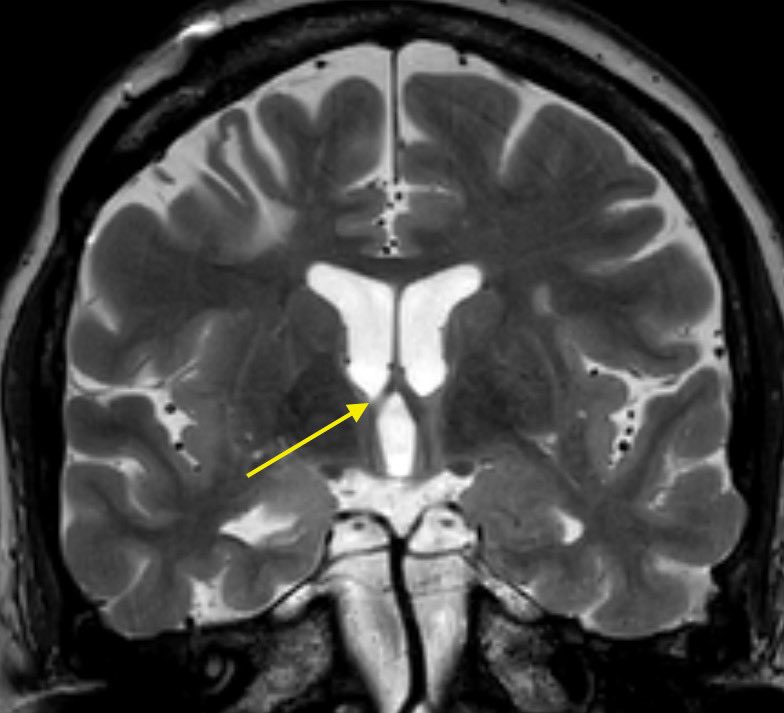 T2/FLAIR: we see atrophy, high signal, and architectural distortion Secondary signs include ipsilateral atrophy of the mammillary body and fornix as seen in this case
