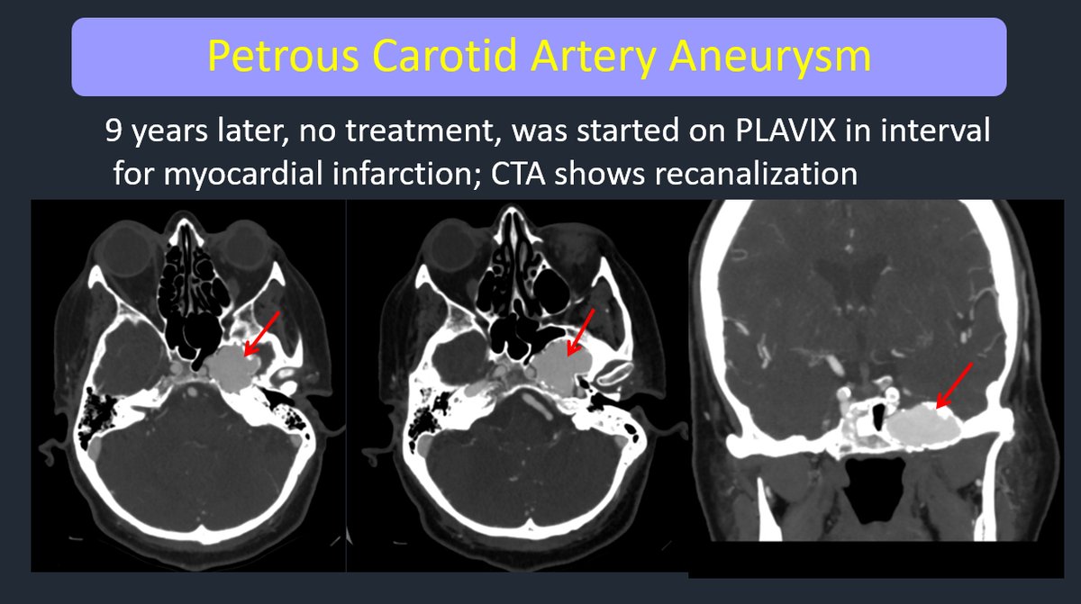 Petrous carotid aneurysms are rare and can be confusing, especially on MRI.
