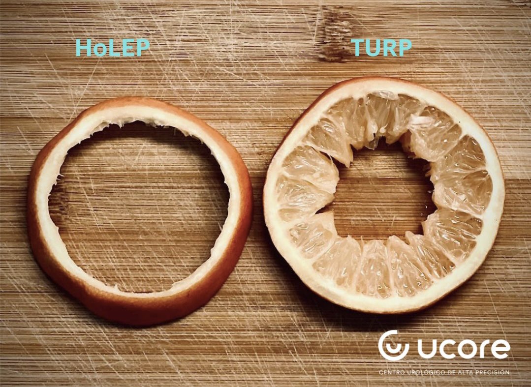 DR CARVAJAL (@romancarvajal) on Twitter photo Ahora que estaba cocinando me recordé de las diferencias entre 😂 #HoLEP y #TURP #UroSoMe <a href="/FCAFigueiredo/">Felipe Figueiredo HoLEP 🇧🇷</a> @GoumasUrologia <a href="/jfunkmd/">Joel Funk MD FACS</a> <a href="/MSGONZALEZURO/">Mariano Sebastian Gonzalez</a> <a href="/drglezb/">drglezb</a> <a href="/IvanMichelM/">Ivan Michel</a> <a href="/lfredosanchez/">Alfredo Sanchez Urólogo</a> <a href="/smumexico/">SMU México</a> <a href="/quanta_system/">Quanta Surgery</a> <a href="/marcial_orozco/">Marcial Orozco Aramiz</a> <a href="/uroledezma/">Rodrigo Ledezma</a> <a href="/RRGonzalezMD/">Ricardo R Gonzalez MD</a> Ahora que estaba cocinando me recordé de las diferencias entre 😂 #HoLEP y #TURP #UroSoMe <a href="/FCAFigueiredo/">Felipe Figueiredo HoLEP 🇧🇷</a> @GoumasUrologia <a href="/jfunkmd/">Joel Funk MD FACS</a> <a href="/MSGONZALEZURO/">Mariano Sebastian Gonzalez</a> <a href="/drglezb/">drglezb</a> <a href="/IvanMichelM/">Ivan Michel</a> <a href="/lfredosanchez/">Alfredo Sanchez Urólogo</a> <a href="/smumexico/">SMU México</a> <a href="/quanta_system/">Quanta Surgery</a> <a href="/marcial_orozco/">Marcial Orozco Aramiz</a> <a href="/uroledezma/">Rodrigo Ledezma</a> <a href="/RRGonzalezMD/">Ricardo R Gonzalez MD</a>