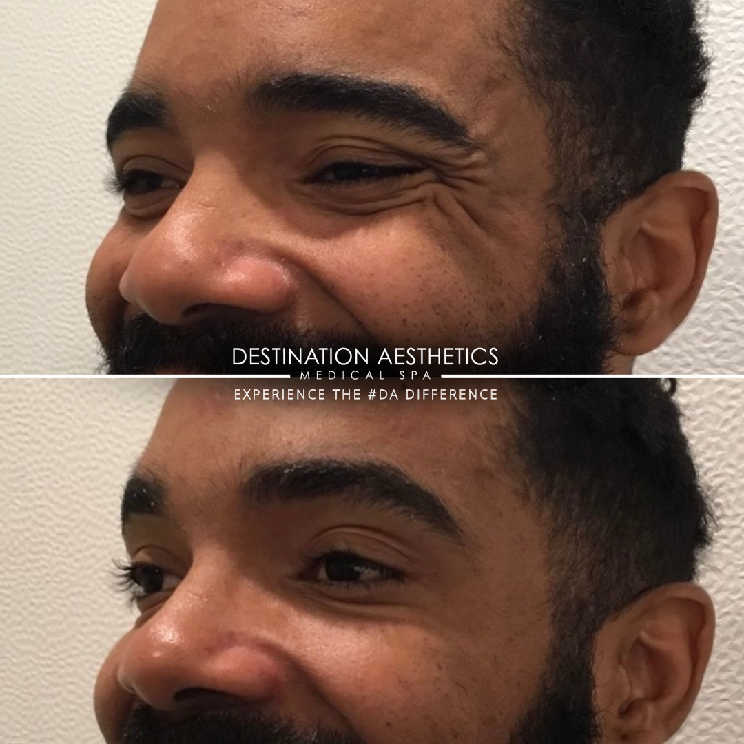 DestAesthetics's tweet photo. COMBO TREATMENT FOR THE WIN ✨! Botox® + smooth PDO Threads around the eyes to stimulate collagen and smooth out the area! 

💉 Provider: Elle May, RN 
📍 Location: #DA Roseville 

If you want to know if you would be a good candidate for this combo treatment, you can schedu https://t.co/1FozJS6En7