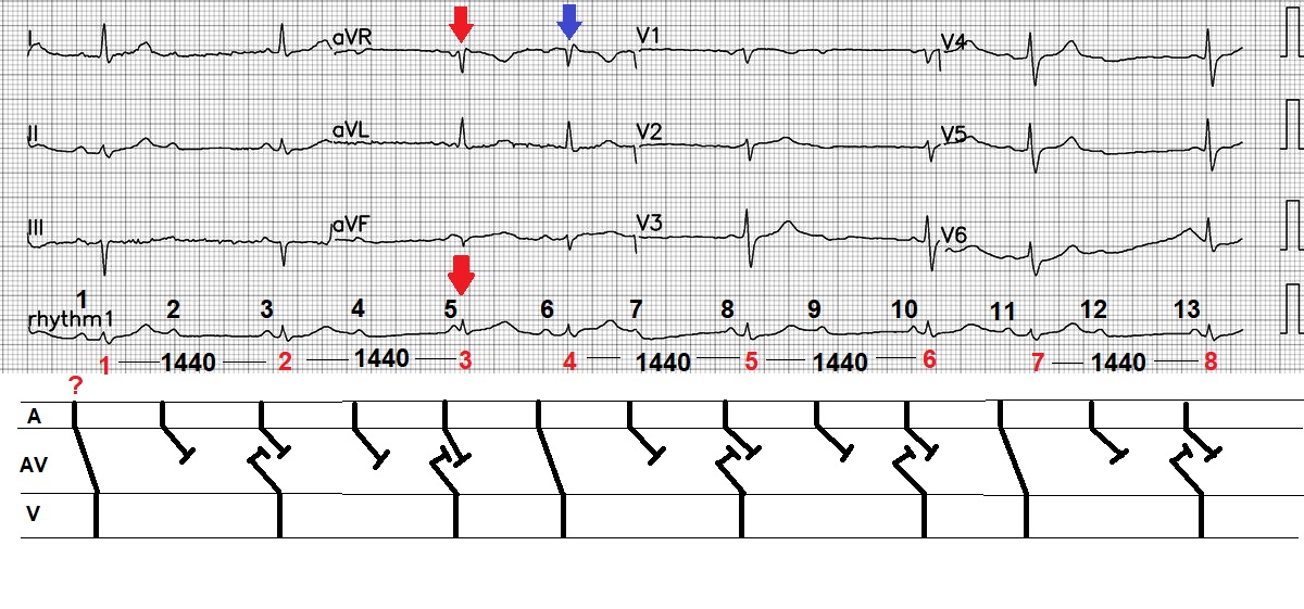 @EcgOxford @MaruanCarlos @The_Nanashi_O @ShariqShamimMD @UlhasDr @DidlakeDW @syamkumarmd @kkananura @DrLindaDykes @DocNikko @AslangerE @Vadeboncoeur_Al @EF_Cardiaca @smithECGBlog @EM_RESUS @EMS12Lead @DruvBhagavan @martinfd78 @estudiomedicina Here is my theory in laddergram. If I have my preference, I would like to have LL1 and prob aVR bev it shows the different QRS morphologies. The escape is based on the deduction observed in R3. So, I think this is SR, 2AVB advance HB. The conducted PRI is ~ 200 ms.