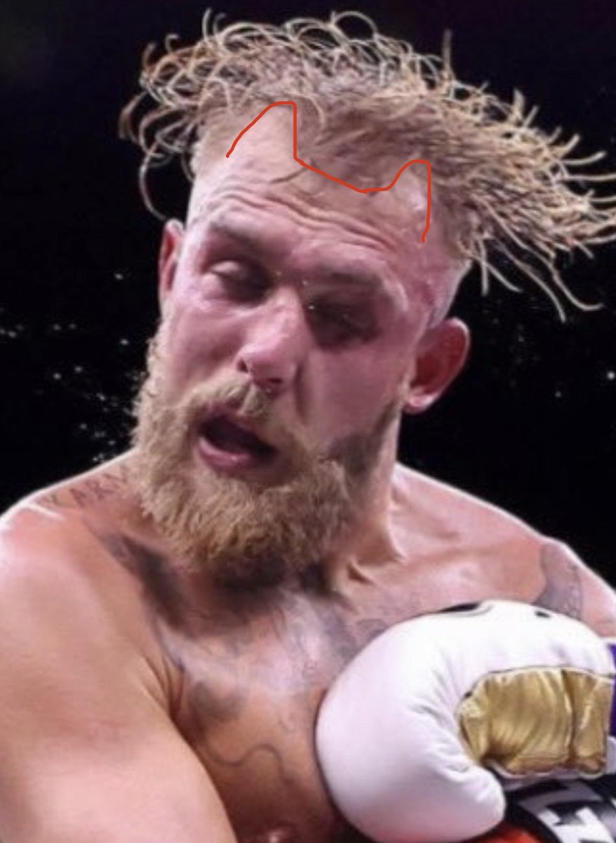 <a href="/raphousetv2/">Raphousetv (RHTV)</a> The hairline of 95% of white boys that got bangs to try and hide that shit 😂