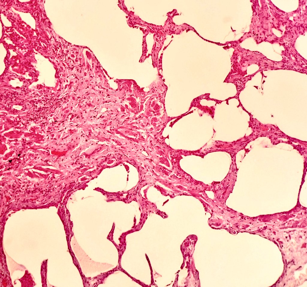 duckhuca's tweet photo. ♂️ 70 years old.
🫁 Upper right lobule biopsy 🔪.
🔬 Usual interstitial pneumonia. https://t.co/DJM5wPbj7s