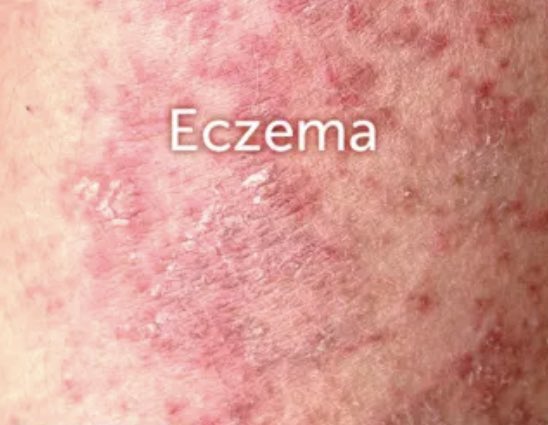ezzahnor's tweet photo. Top 10 shower gel/wash for eczema &amp; sensitive skin. 

Itchy &amp; dry skin peeps, this thread is for you: https://t.co/35u9BHNJ9t