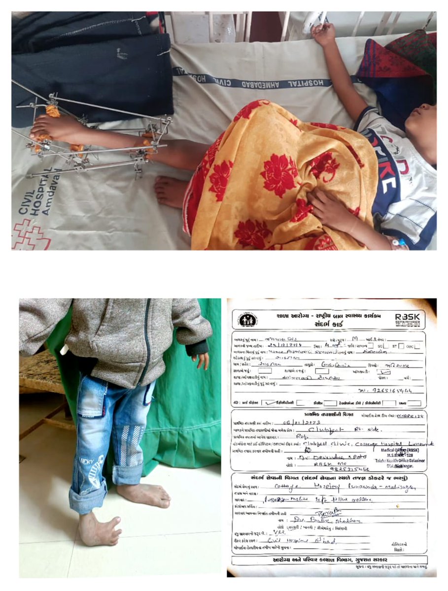 MahisagarRbsk's tweet photo. Club foot child successfull operated by JESS surgical method  at Civil Hospital Ahmedabad on 26-02-2023. Team MSBRR 128
SH-RBSK MAHISAGAR
@PMOIndia @CMOGuj @GujHFWDept @Rushikeshmla https://t.co/ILzzlqscTX
